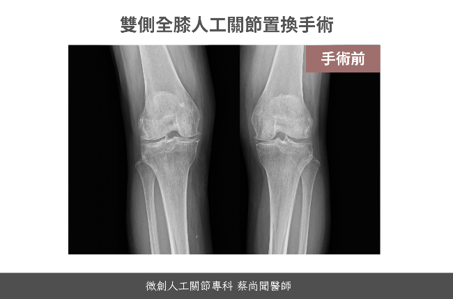 蔡尚聞醫師評價-人工關節
