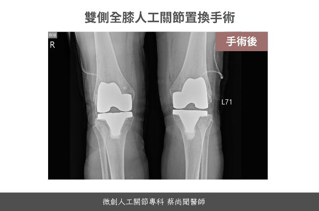 蔡尚聞醫師評價-人工關節