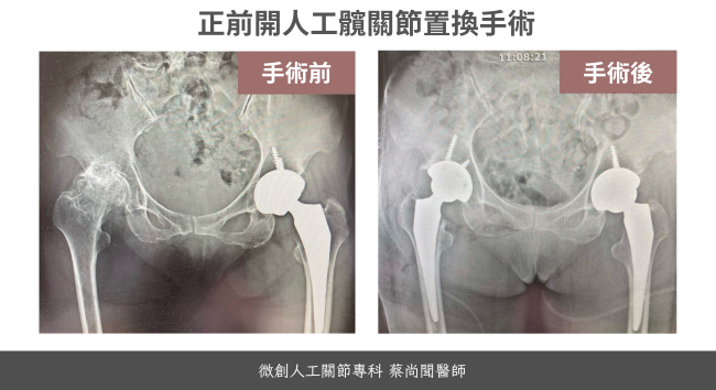 人工髖關節手術