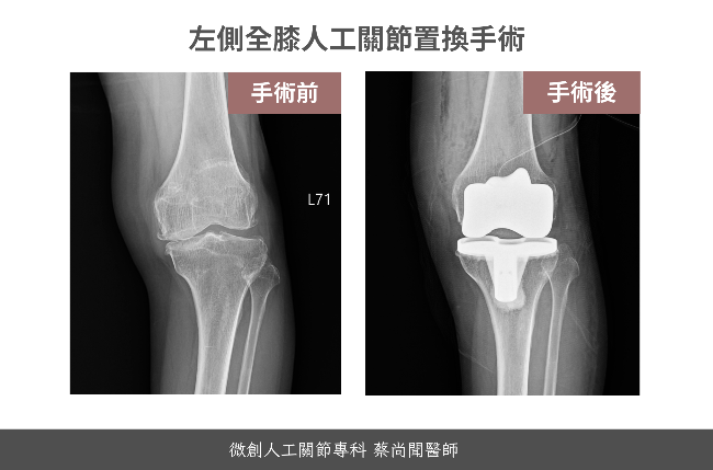 人工關節-蔡尚聞