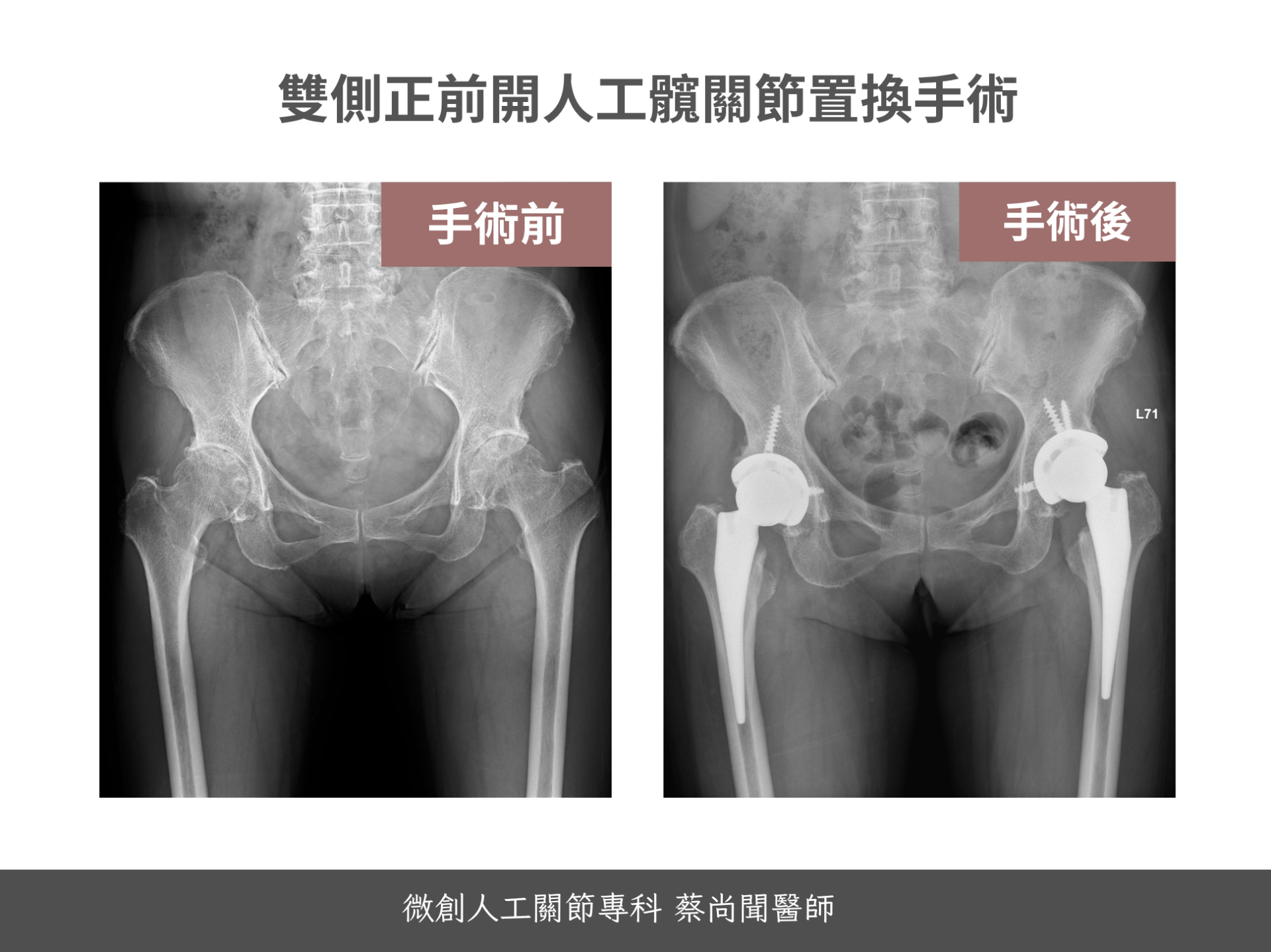 人工髖關節心得 人工髖關節心得