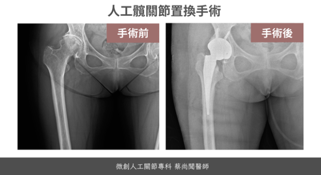 人工髖關節手術