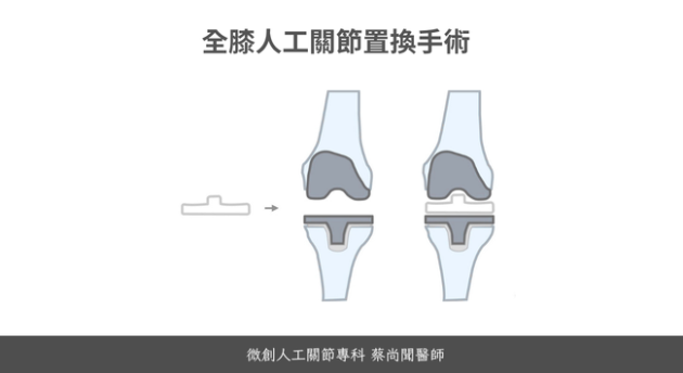 人工膝關節置換術