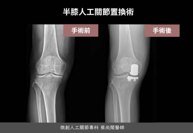半膝人工關節置換術