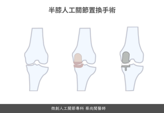 半膝人工關節置換